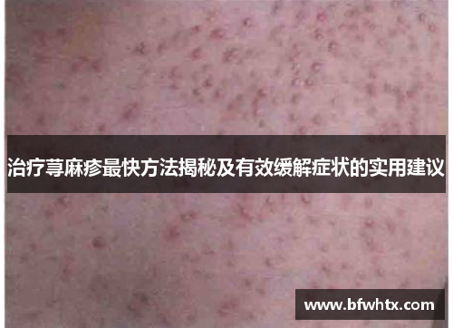治疗荨麻疹最快方法揭秘及有效缓解症状的实用建议